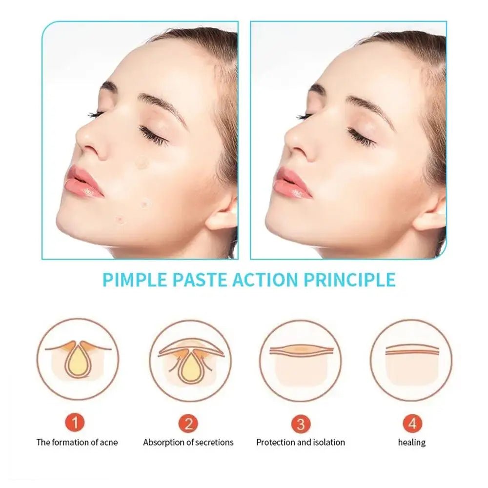 Acne Pimple Patch Invisível – Tratamento Rápido e Eficaz - BOLDORA